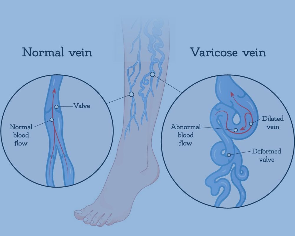 When Varicose Veins Painful Here's Why Blog South Valley